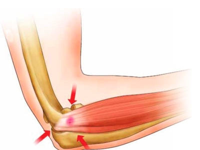 My elbow hurts when playing padel: 3 changes that can save your season